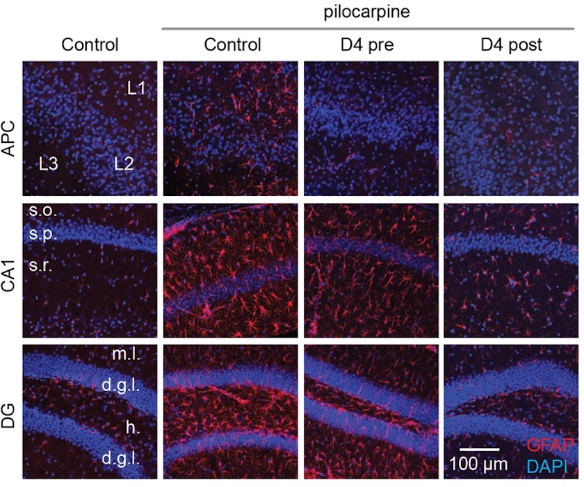 D4 treatment decreases proliferation and activation of astrocytes in two different brain regions. Pilocarpine was injection into mice intraperitoneally to induce seizures. Seven days after pilocarpine-induced seizures, we observed a chronic elevation of the number of astrocytes. Pre-pilocarpine or post-pilocarpine, single injection of the new hemichannel antagonist D4 significantly curbs the proliferation of astrocytes, thus reducing neuroinflammation. APC, anterior piriform cortex; CA1, cornu ammonis area 1 of the hippocampus; DG, dentate gyrus area of the hippocampus; GFAP, glial fibrillary acidic protein (marker of astrocytes); DAPI, marker of cell nuclei; L1, L2, L3, layers 1, 2 and 3 of APC; s.o., Stratum oriens; s.p., Stratum pyramidale; s.r., Stratum radiatum; m.l., molecular layer; d.g.l., dentate granule cell layer; h, hilus.