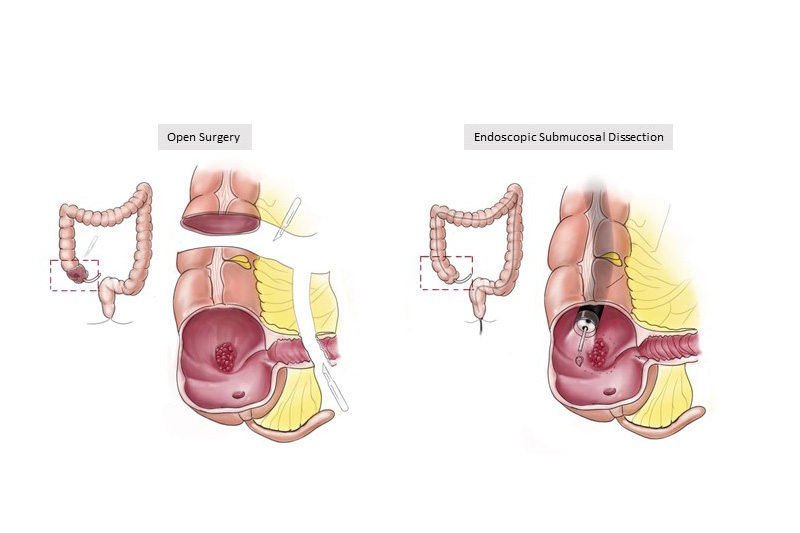 A biomarker for categorizing colorectal cancer patients
